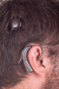 Cochlear implant shown on a man's head...